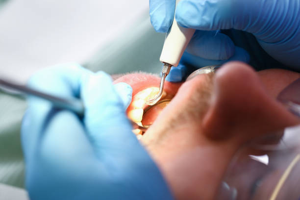 Best Emergency Wisdom Teeth Removal in Nicoma Park, OK